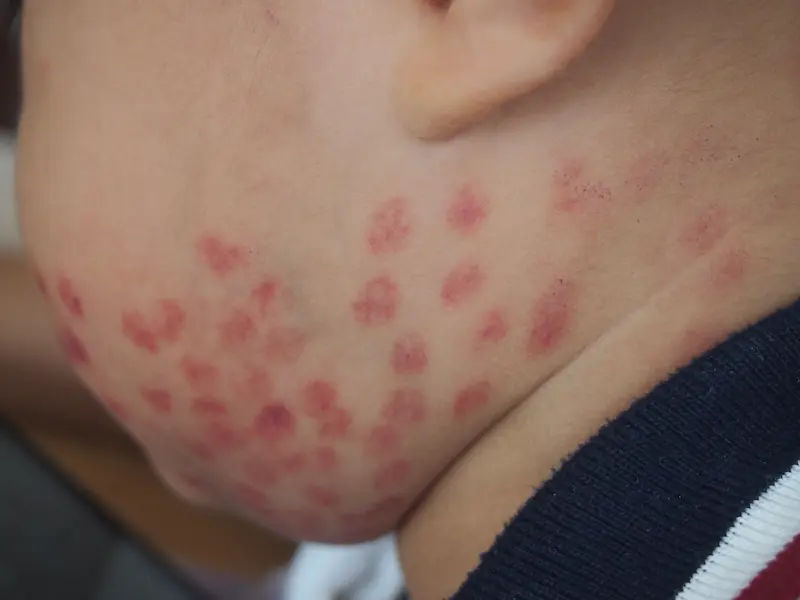Types of Hemangiomas and Their Characteristics